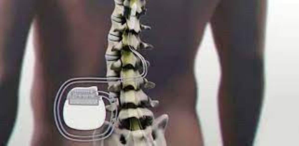 stimolazione spinale